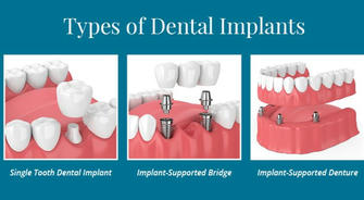 Dental Implants or Dentures: A Simple Guide for Seniors